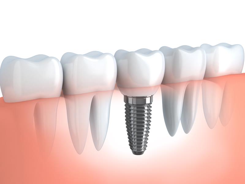 Dental Implants  Fort Smith, AR 