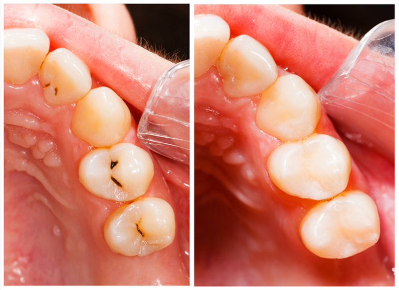 Fillings  Fort Smith, AR