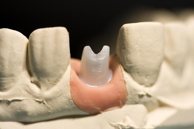 Implant Restoration  Fort Smith, AR 