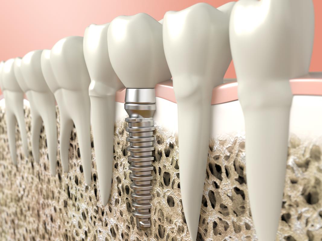 Dental Implants  Fort Smith, AR 