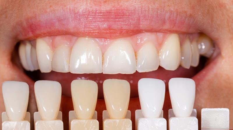 Veneers Fort Smith, AR